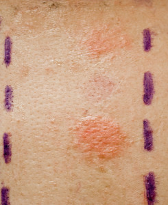 bőr próbás allergia teszt