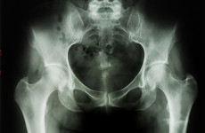 A kezeletlen cöliákia miatt a csontritkulásra is nagyobb esély van!