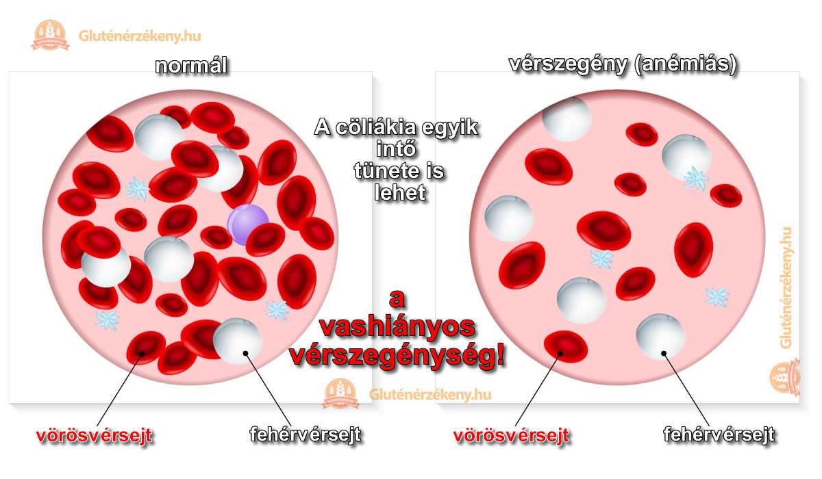Ezek a vérkép eltérések utalnak vérszegénységre
