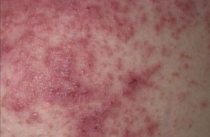 lisztérzékenység bőrproblémák gluténérzékenység tünetei